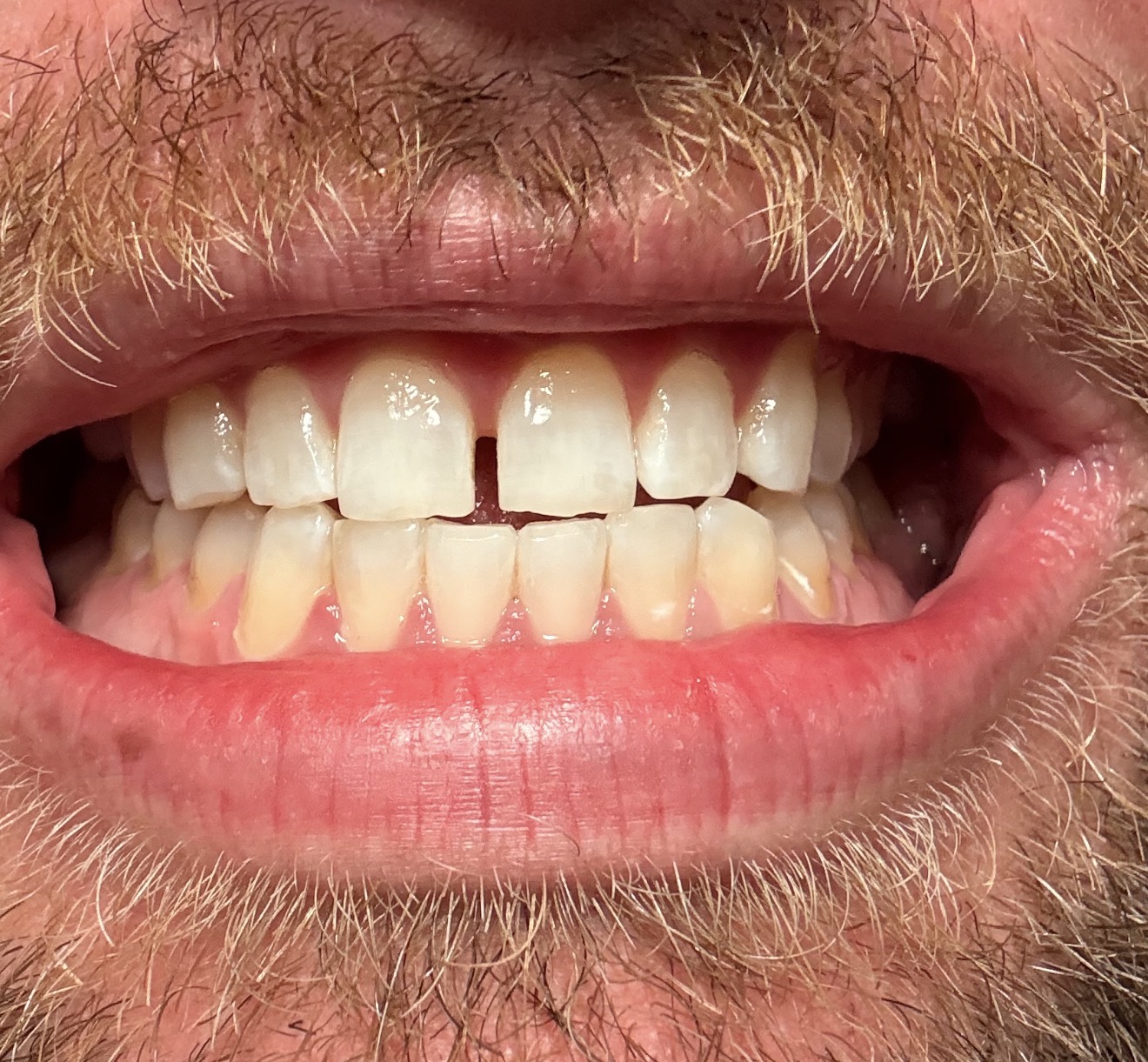 Close-up of a guest's brighter, whiter smile after a cosmetic whitening session