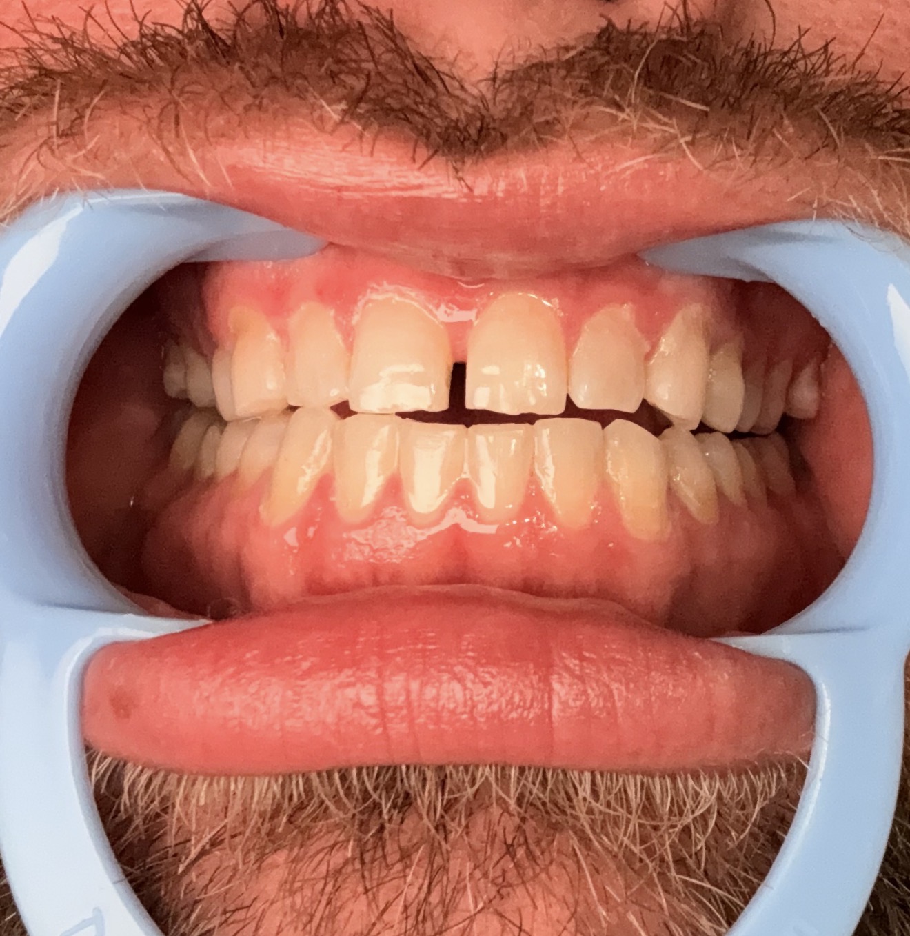 Close-up of a guest's smile before a cosmetic whitening session